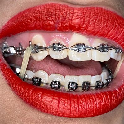 Cassy Braces